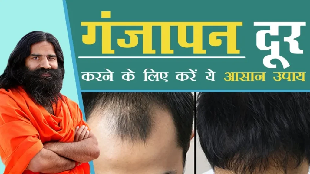 Ganjapan Kaise Dur Kare | गंजापन कैसे दूर करें (How to Reduce or Reverse Baldness Naturally & Medically) 10 ganjapan kaise dur kare